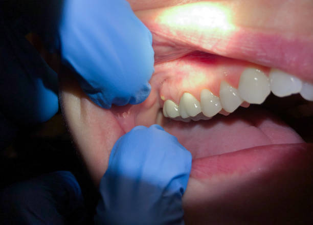 Best Emergency Dental Care for Abscessed Tooth in Liberty Triangle, FL